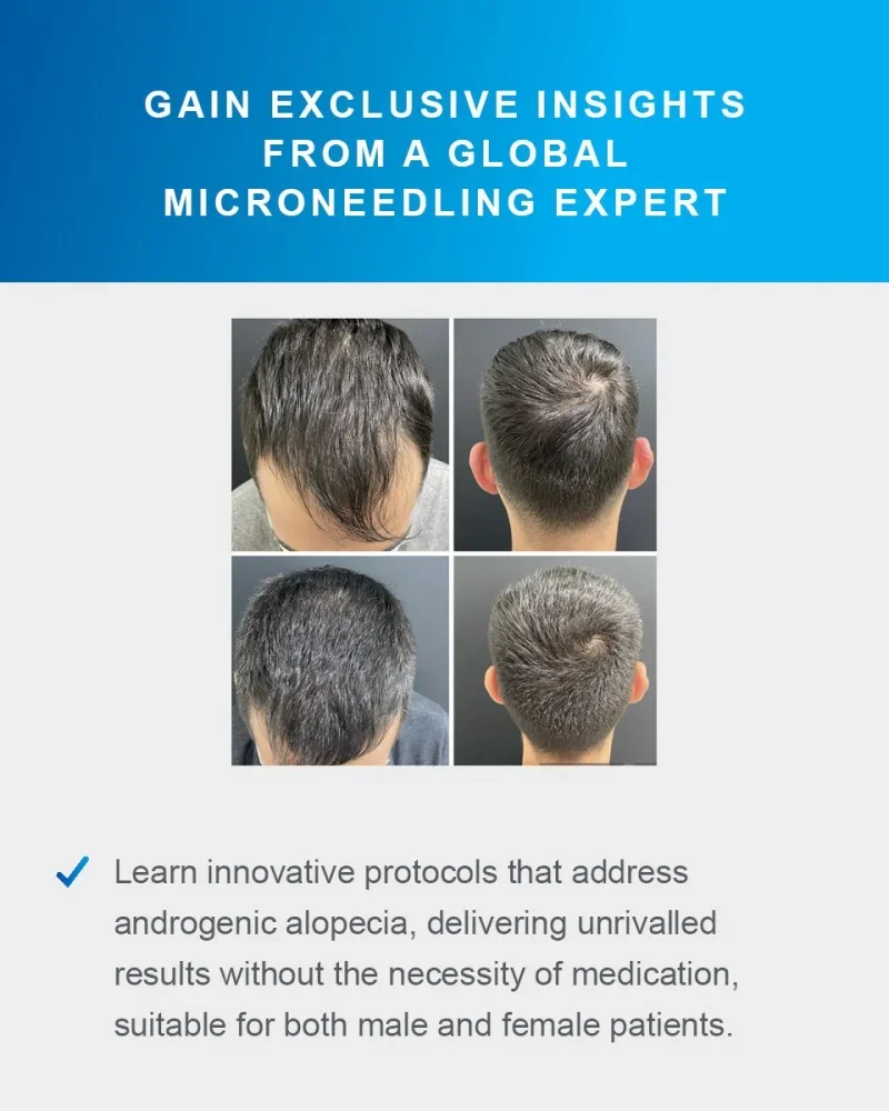 resultados-alopecia-androgenetica-1.webp