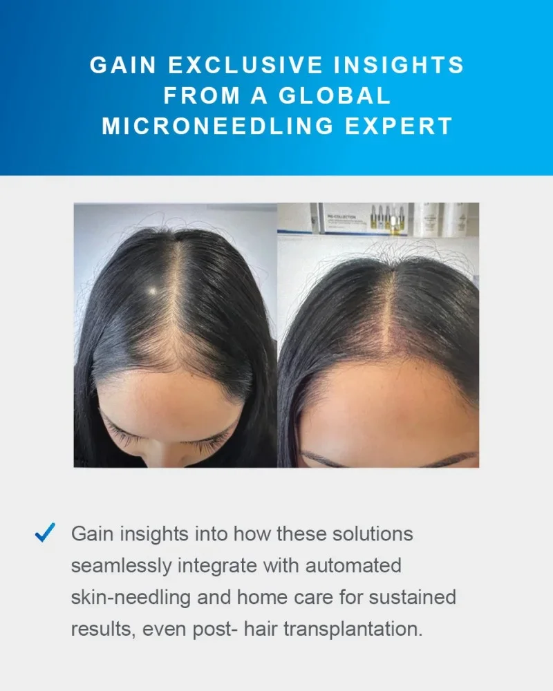 resultados-alopecia-androgenetica-2.webp