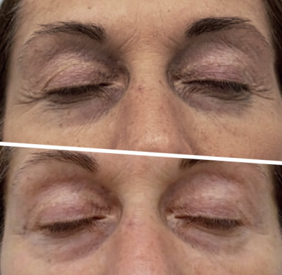 Resultado antes e depois — tratamento desfatigante