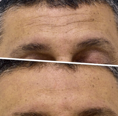Resultado antes e depois — tratamento de efeito lifting