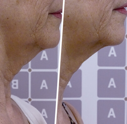 Resultado antes e depois — tratamento remodelador